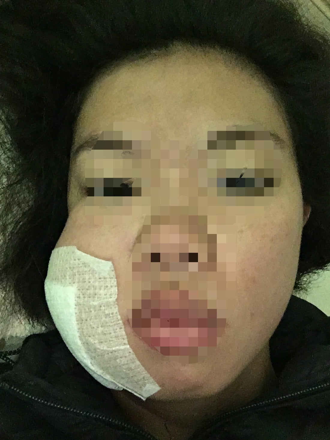 拔智齒所導致的蜂窩性組織炎